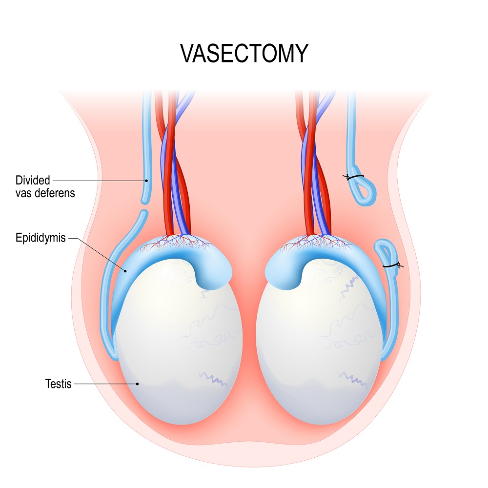 Everything About Vasectomies